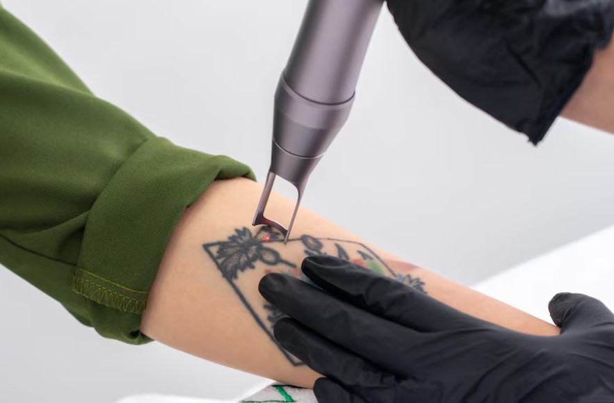 Advanced Permanent Tattoo Removal in Kissimmee