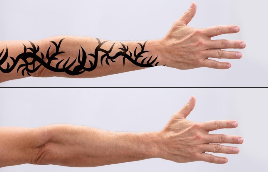 Permanent Tattoo Removal in Kissimmee: Get Rid of That Tattoo
